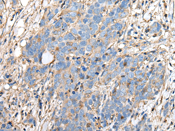 Immunohistochemistry of paraffin-embedded Human thyroid cancer tissue  using PLA2G16 Polyclonal Antibody at dilution of 1:40(×200)