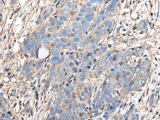 Immunohistochemistry of paraffin-embedded Human thyroid cancer tissue  using PLA2G16 Polyclonal Antibody at dilution of 1:40(×200)