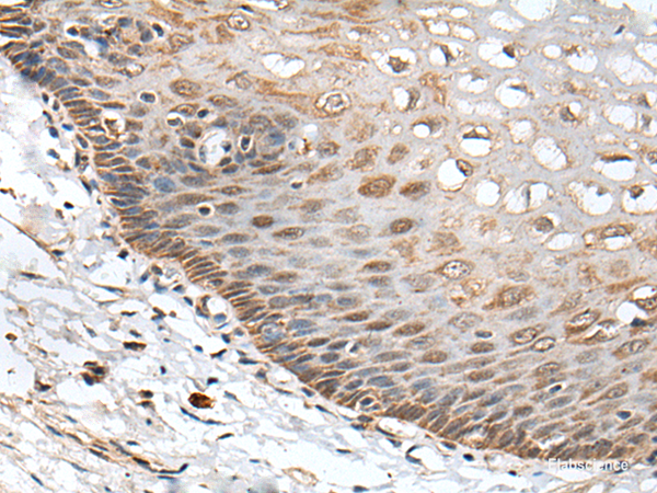 Immunohistochemistry of paraffin-embedded Human esophagus cancer tissue  using CHRNA5 Polyclonal Antibody at dilution of 1:50(×200)