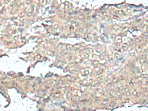 Immunohistochemistry of paraffin-embedded Human ovarian cancer tissue  using MEF2D Polyclonal Antibody at dilution of 1:50(×200)