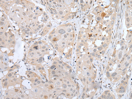 Immunohistochemistry of paraffin-embedded Human esophagus cancer tissue  using BORCS8 Polyclonal Antibody at dilution of 1:50(×200)