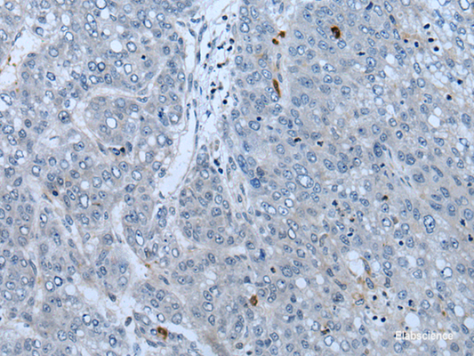 Immunohistochemistry of paraffin-embedded Human liver cancer tissue  using NF1 Polyclonal Antibody at dilution of 1:65(×200)