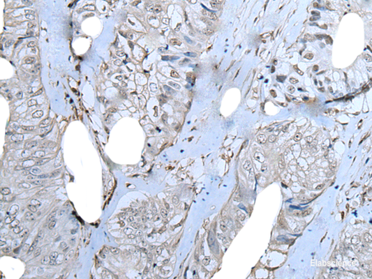 Immunohistochemistry of paraffin-embedded Human colorectal cancer tissue  using ZNF703 Polyclonal Antibody at dilution of 1:40(×200)