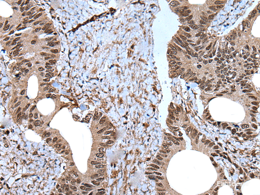 Immunohistochemistry of paraffin-embedded Human colorectal cancer tissue  using ZNF787 Polyclonal Antibody at dilution of 1:45(×200)