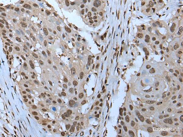 Immunohistochemistry of paraffin-embedded Human esophagus cancer tissue  using ZNHIT3 Polyclonal Antibody at dilution of 1:95(×200)