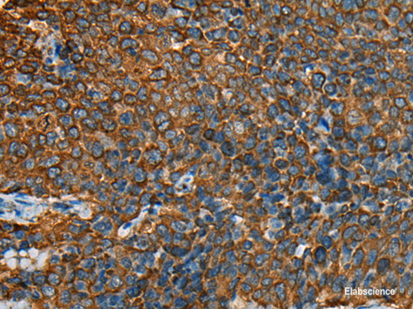 Immunohistochemistry of paraffin-embedded Human cervical cancer tissue  using YBX1 Polyclonal Antibody at dilution of 1:25(×200)