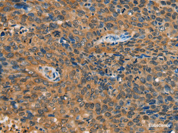 Immunohistochemistry of paraffin-embedded Human cervical cancer tissue  using YTHDF1 Polyclonal Antibody at dilution of 1:55(×200)