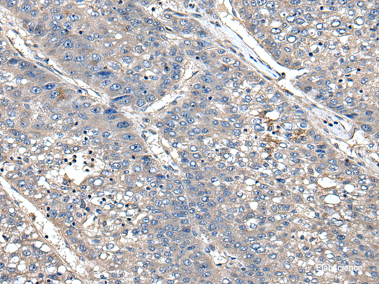 Immunohistochemistry of paraffin-embedded Human liver cancer tissue  using XDH Polyclonal Antibody at dilution of 1:85(×200)