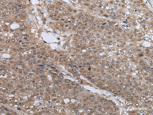 Immunohistochemistry of paraffin-embedded Human liver cancer tissue  using UBE4B Polyclonal Antibody at dilution of 1:40(×200)