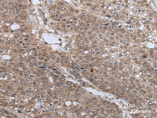 Immunohistochemistry of paraffin-embedded Human liver cancer tissue  using UBE4B Polyclonal Antibody at dilution of 1:40(×200)