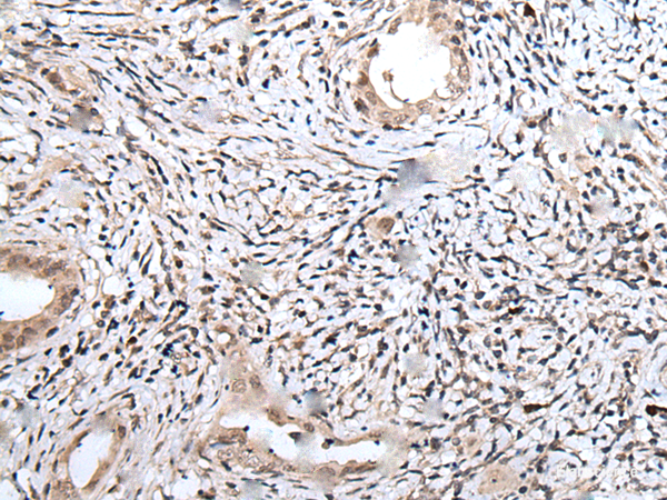 Immunohistochemistry of paraffin-embedded Human cervical cancer tissue  using UBN1 Polyclonal Antibody at dilution of 1:75(×200)