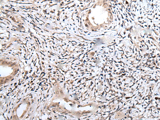 Immunohistochemistry of paraffin-embedded Human cervical cancer tissue  using UBN1 Polyclonal Antibody at dilution of 1:75(×200)