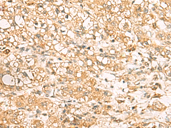 Immunohistochemistry of paraffin-embedded Human liver cancer tissue  using USP24 Polyclonal Antibody at dilution of 1:35(×200)