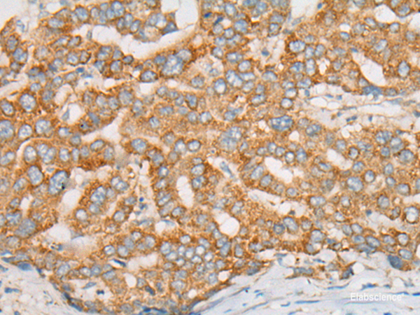 Immunohistochemistry of paraffin-embedded Human liver cancer tissue  using ATXN7 Polyclonal Antibody at dilution of 1:60(×200)