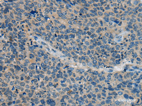 Immunohistochemistry of paraffin-embedded Human cervical cancer tissue  using BACE2 Polyclonal Antibody at dilution of 1:45(×200)
