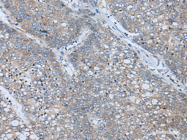 Immunohistochemistry of paraffin-embedded Human liver cancer tissue  using BICD2 Polyclonal Antibody at dilution of 1:70(×200)