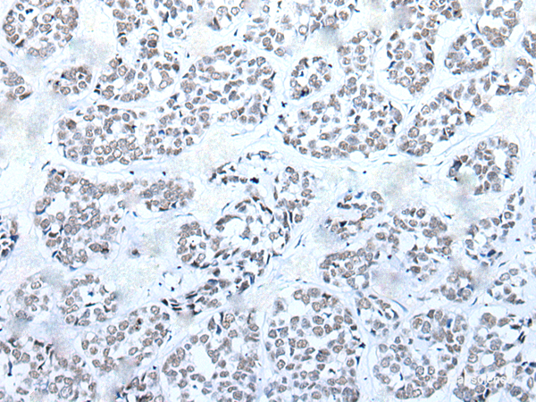 Immunohistochemistry of paraffin-embedded Human esophagus cancer tissue  using BRD3 Polyclonal Antibody at dilution of 1:60(×200)