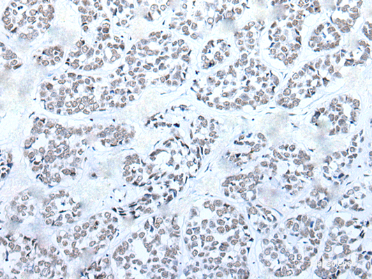 Immunohistochemistry of paraffin-embedded Human esophagus cancer tissue  using BRD3 Polyclonal Antibody at dilution of 1:60(×200)