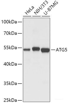 Immunohistochemistry of paraffin-embedded Human lung cancer using TEK Polyclonal Antibody at dilution of  1:100 (40x lens).