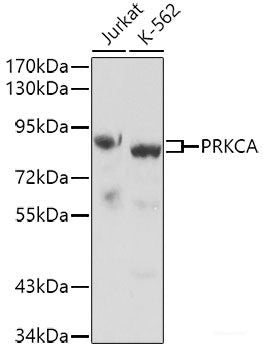 Immunohistochemistry of paraffin-embedded Human liver cancer using RAP1A Polyclonal Antibody at dilution of  1:100 (40x lens).