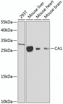 Immunohistochemistry of paraffin-embedded Human mammary cancer using AKT Polyclonal Antibody at dilution of  1:100 (40x lens).