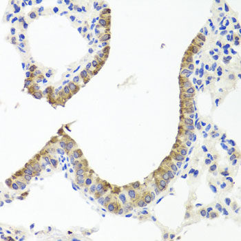 Immunohistochemistry of paraffin-embedded Human lung cancer using SRC Polyclonal Antibody at dilution of  1:100 (40x lens).