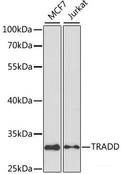 Immunohistochemistry of paraffin-embedded Human mammary cancer using Caspase-3 Polyclonal Antibody at dilution of  1:200 (40x lens).
