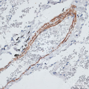 Immunohistochemistry of paraffin-embedded Human lung cancer using TrkB Polyclonal Antibody at dilution of  1:200 (40x lens).