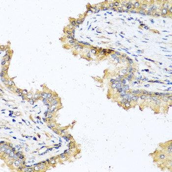 Immunohistochemistry of paraffin-embedded Human lung cancer using PRSS1 Polyclonal Antibody at dilution of  1:100 (40x lens).