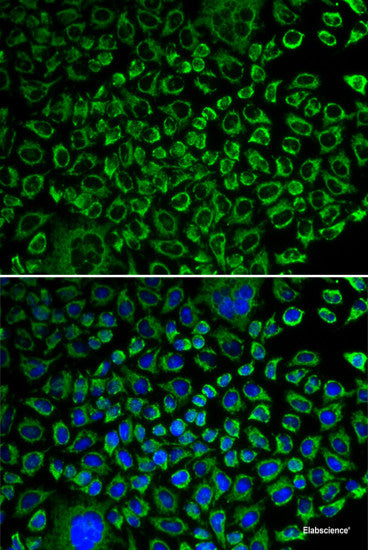 Immunohistochemistry of paraffin-embedded Human thyroid cancer using S100A5 Polyclonal Antibody at dilution of  1:100 (40x lens).