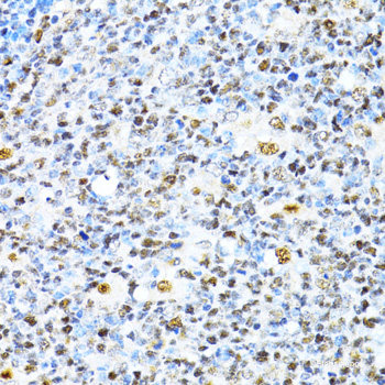 Immunohistochemistry of paraffin-embedded Human lung cancer using NCSTN Polyclonal Antibody at dilution of  1:100 (40x lens).