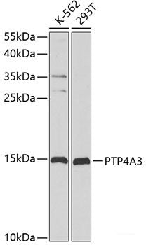 Immunohistochemistry of paraffin-embedded Human liver cancer using CYP2E1 Polyclonal Antibody at dilution of  1:100 (40x lens).