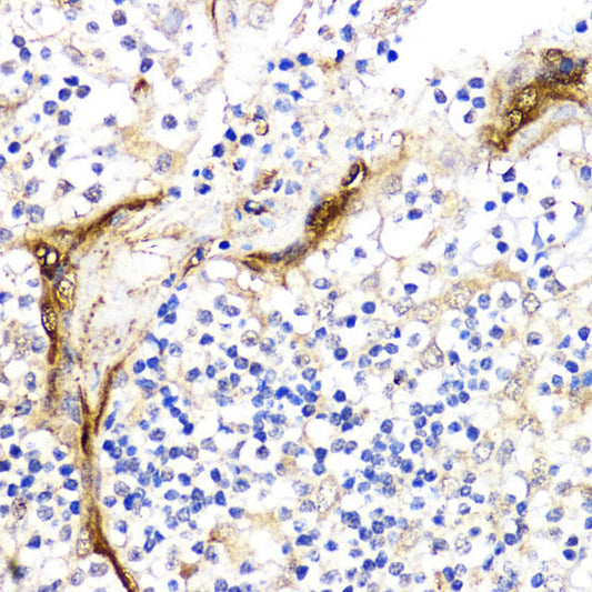 Immunohistochemistry of paraffin-embedded Human lung cancer using EIF4E Polyclonal Antibody at dilution of  1:100 (40x lens).