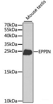 Immunohistochemistry of paraffin-embedded Human mammary cancer using WNT1 Polyclonal Antibody at dilution of  1:100 (40x lens).