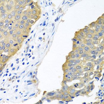 Immunohistochemistry of paraffin-embedded Human colon carcinoma using LYZ Polyclonal Antibody at dilution of  1:100 (40x lens).