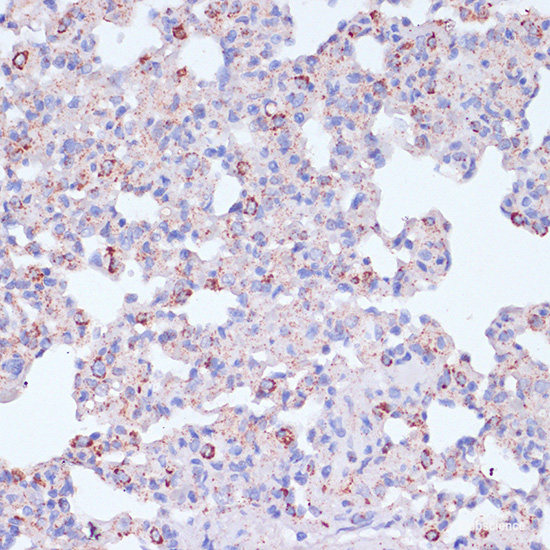 Immunohistochemistry of paraffin-embedded Human lung cancer using TIM-3/HAVCR2 Polyclonal Antibody at dilution of  1:200 (40x lens).