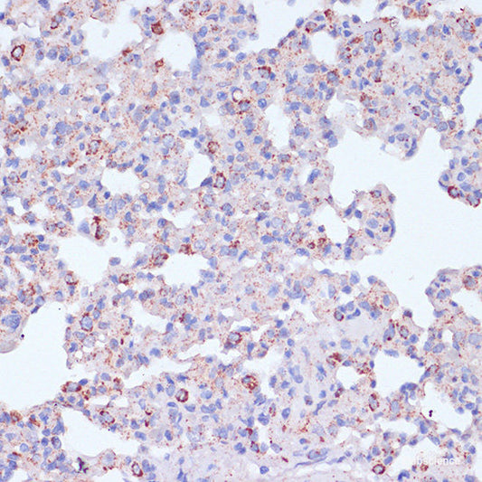 Immunohistochemistry of paraffin-embedded Human lung cancer using TIM-3/HAVCR2 Polyclonal Antibody at dilution of  1:200 (40x lens).