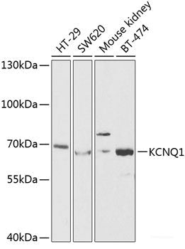 Immunohistochemistry of paraffin-embedded Human stomach cancer using GYS1 Polyclonal Antibody at dilution of  1:200 (40x lens).