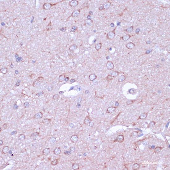 Immunohistochemistry of paraffin-embedded Human liver cancer using STAT3 Polyclonal Antibody at dilution of  1:100 (40x lens).