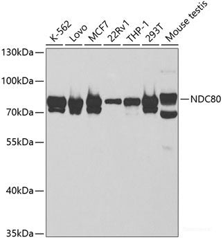 Immunohistochemistry of paraffin-embedded Human mammary cancer using CREM Polyclonal Antibody at dilution of  1:100 (40x lens).