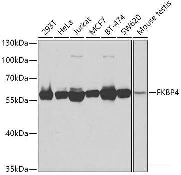Immunohistochemistry of paraffin-embedded Human esophageal cancer using PRKCQ Polyclonal Antibody at dilution of  1:200 (40x lens).