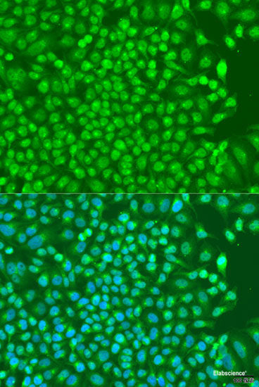 Immunohistochemistry of paraffin-embedded Human adenomyosis using PHC1 Polyclonal Antibody at dilution of  1:200 (40x lens).