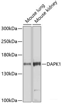 Immunohistochemistry of paraffin-embedded Human lung cancer using HTATSF1 Polyclonal Antibody at dilution of  1:100 (40x lens).