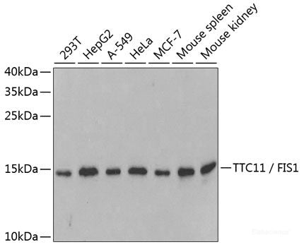 Immunohistochemistry of paraffin-embedded Human liver cancer using PIGR Polyclonal Antibody at dilution of  1:100 (40x lens).
