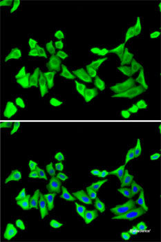 Immunohistochemistry of paraffin-embedded Human liver cancer using LY86 Polyclonal Antibody at dilution of  1:200 (40x lens).