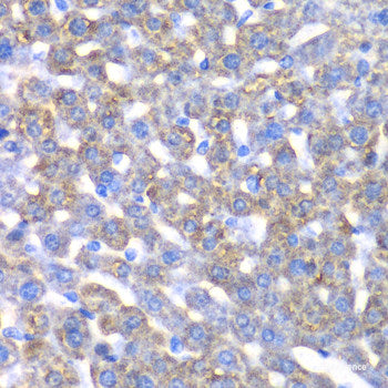 Immunohistochemistry of paraffin-embedded Human well-differentiated squamous skin carcinoma using PUF60 Polyclonal Antibody at dilution of  1:100 (40x lens).