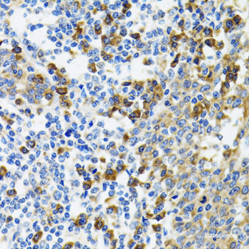 Immunohistochemistry of paraffin-embedded Human liver damage using TRAF3IP2 Polyclonal Antibody at dilution of  1:100 (40x lens).