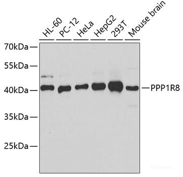 Immunohistochemistry of paraffin-embedded Human liver cancer using DHODH Polyclonal Antibody at dilution of  1:100 (40x lens).