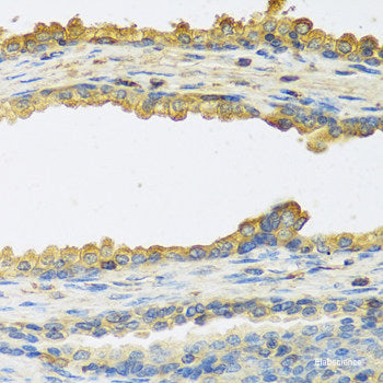 Immunohistochemistry of paraffin-embedded Human colon carcinoma using SSBP1 Polyclonal Antibody at dilution of  1:100 (40x lens).