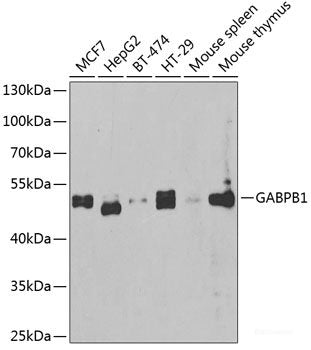 Immunohistochemistry of paraffin-embedded Human well-differentiated squamous skin carcinoma using DNAJB6 Polyclonal Antibody at dilution of  1:100 (40x lens).